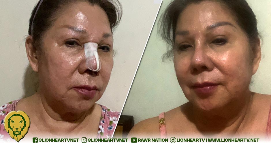 LOOK: Beverly Salviejo reveals Rhinoplasty